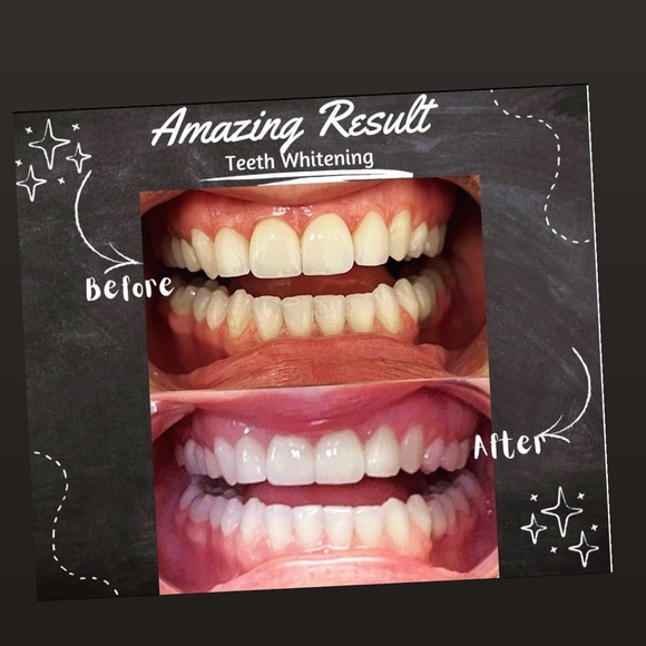 Professional Teeth Whitening Kit - Picture 3 of 3